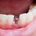 The Importance of Healing and Recovery in the Dental Implant Procedure