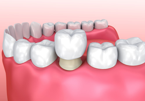 The Different Materials Used for Dental Crowns