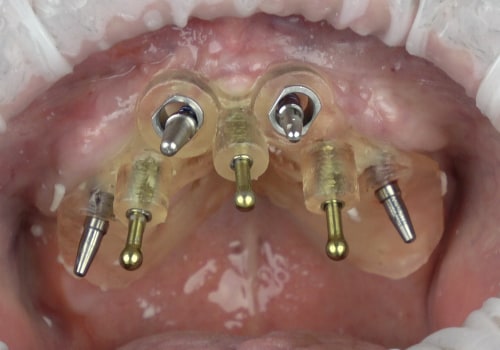 Evaluation and Planning: The Key to a Successful Implant Procedure