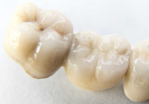 The Beauty and Benefits of Traditional Bridges for Dental Crowns