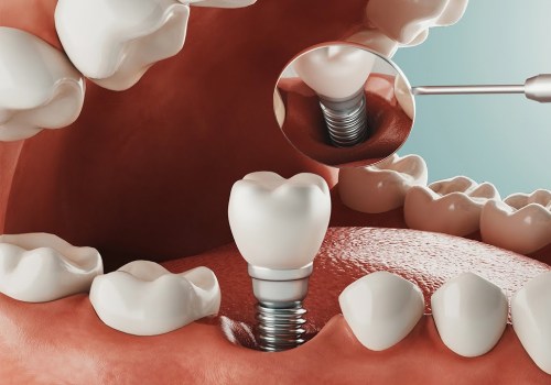 Improving Your Quality of Life: The Benefits of Restorative Dentistry