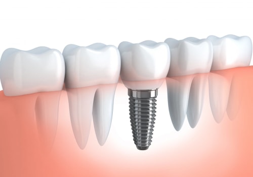 Implant Placement Surgery: What to Expect and How to Prepare