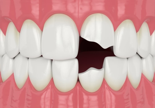 Broken Tooth Repair: Everything You Need to Know