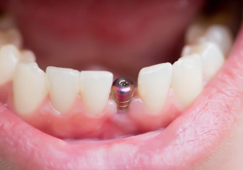 The Importance of Healing and Recovery in the Dental Implant Procedure