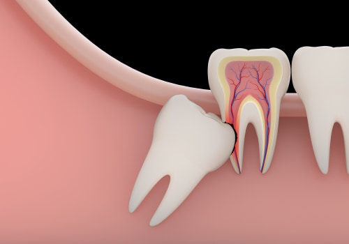 The Truth About Wisdom Teeth Removal